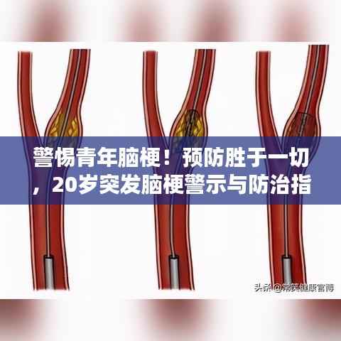 警惕青年脑梗!预防胜于一切,20岁突发脑梗警示与防治指南